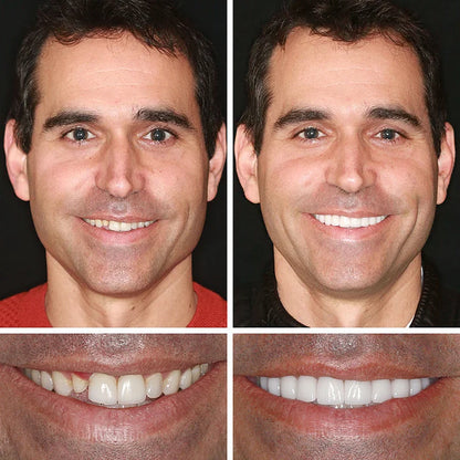 ⏰Yagoo™ Medical Full Denture with Strong Suctiond🦷Obtain American Dental Association (ADA) Certification