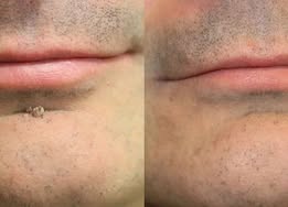 ✨Lumivo®2-in-1 Microneedle & Hydrocolloid Patch🍀| Removes Raised Moles, Acne, Flat Warts & Skin Tags | Helps Improve Wrinkles, Scars & Blemishes | Invisible Patches for Face & Body