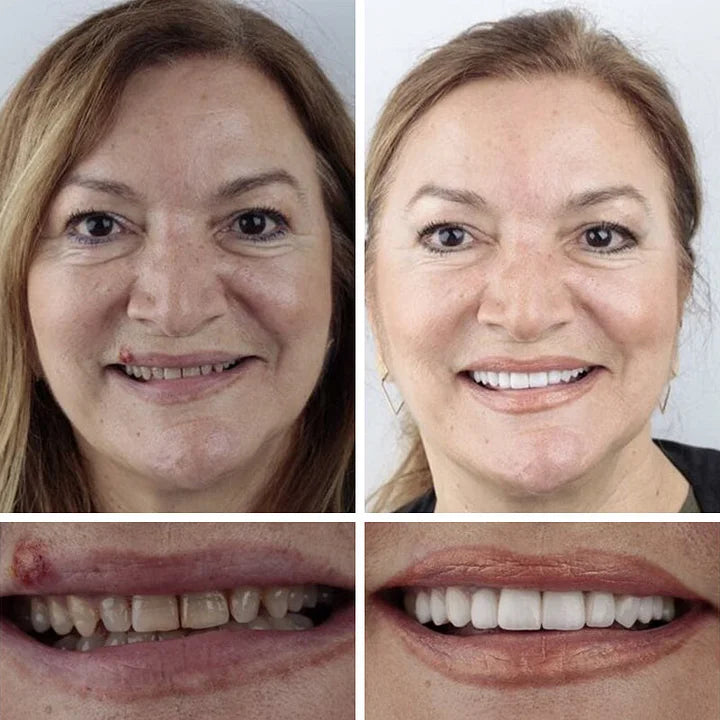 ⏰Yagoo™ Medical Full Denture with Strong Suctiond🦷Obtain American Dental Association (ADA) Certification