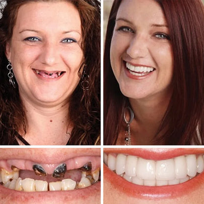 ⏰Yagoo™ Medical Full Denture with Strong Suctiond🦷Obtain American Dental Association (ADA) Certification